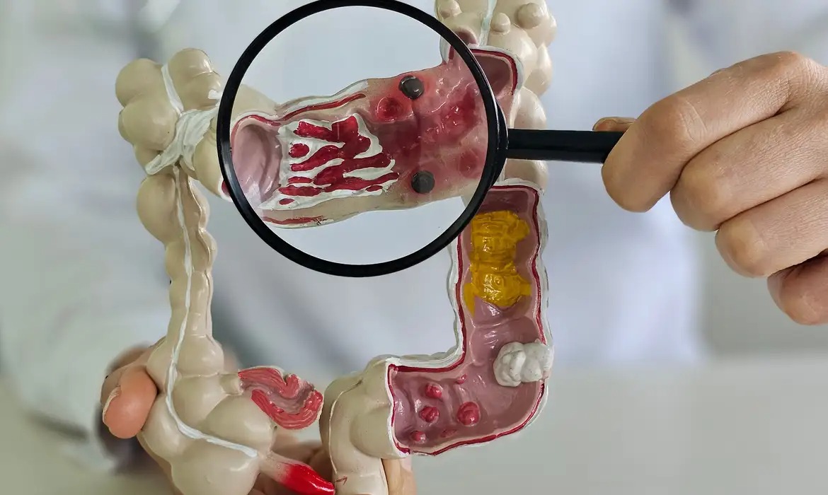 Doença inflamatória intestinal pode crescer 67% até 2035